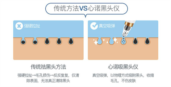 吸黑头是什么原理_黑头是什么样子图片(2)
